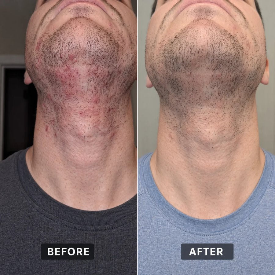 Before and after neck skin comparison after using Between Shaves
